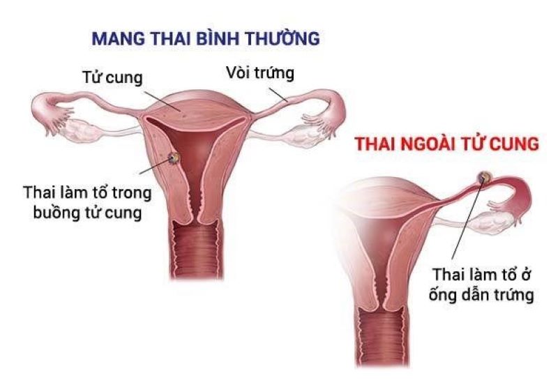 Hình ảnh minh họa mang thai bình thường và mang thai ngoài tử cung 