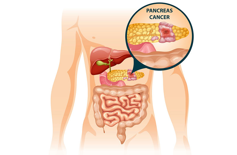 Ung thư tuyến tụy là gì - Đây là dạng ung thư khởi phát tại tuyến tụy