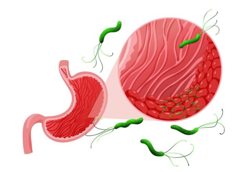 Vi khuẩn HP có khả năng tồn tại trong môi trường axit khắc nghiệt của dạ dày