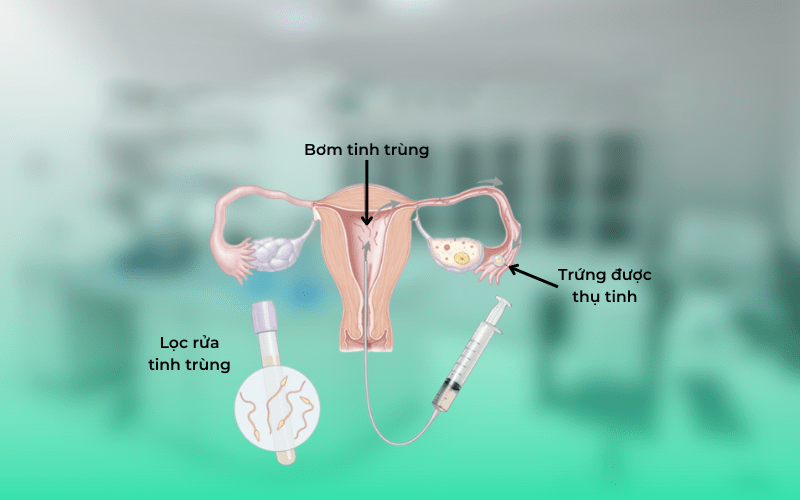 Tinh trùng được lọc rửa và đem đi bơm vào buồng tử cung