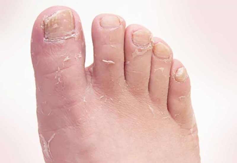 Dấu hiệu nhận biết khi bị nấm da chân hiệu quả và tự nhiên