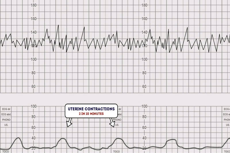 Cơn co tử cung là một trong những yếu tố quyết định của chuyển dạ thất bại