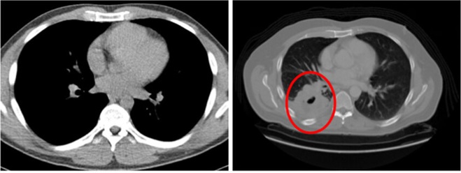  Hình ảnh cắt lớp vi tính của phổi bình thường (bên trái) và ung thư phổi (bên phải)