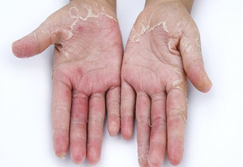 Bệnh viêm da lòng bàn tay có triệu chứng gì?