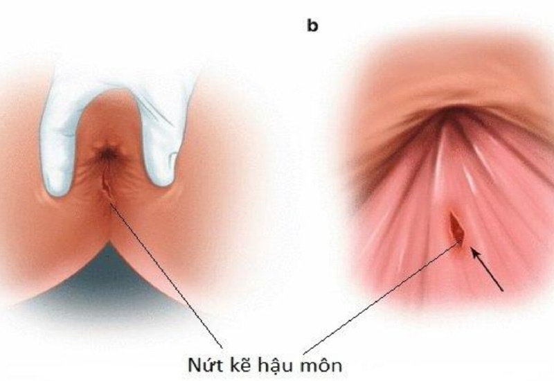 Viêm da quanh hậu môn là gì? 
