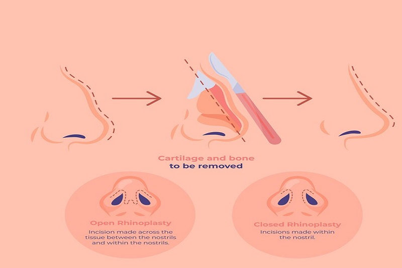 Mô phỏng quá trình khắc phục khuyết điểm để tái tạo dáng mũi theo phương pháp nâng mũi cấu trúc