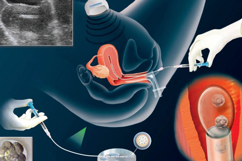 Khi thụ tinh nhân tạo, tinh trùng được bơm vào tử cung bằng dụng cụ chuyên dụng