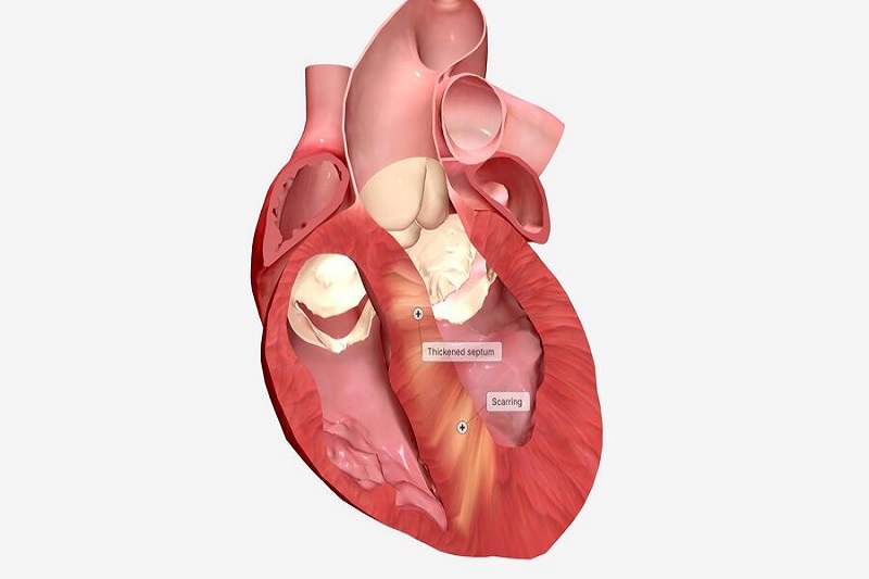 Mắc bệnh tim phì đại là một trong các nguyên nhân gây bất thường chỉ số tim ngực và tăng kích thước bóng tim