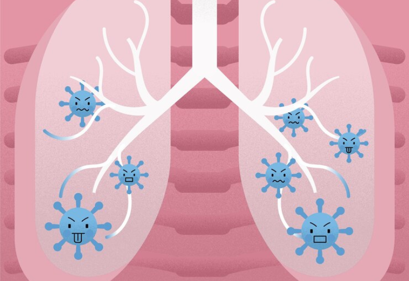 Viêm phổi là một bệnh lý nhiễm trùng ở phổi, chủ yếu do vi khuẩn, virus, nấm