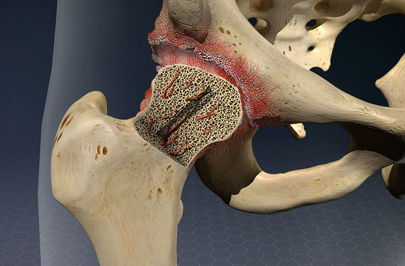 Tìm hiểu về hoại tử xương và các phương pháp điều trị