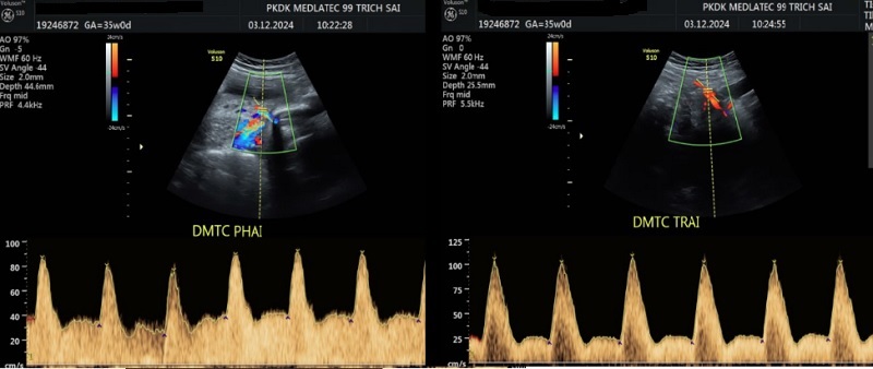 Kết quả siêu âm phát hiện sản phụ khuyết tiền tâm trương động mạch tử cung hai bên và PI tăng