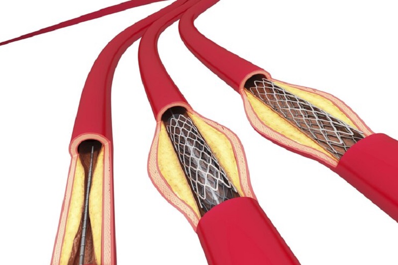 Chi phí đặt stent mạch máu não tương đối cao do tính chất phức tạp của phẫu thuật và giá thành vật liệu stent