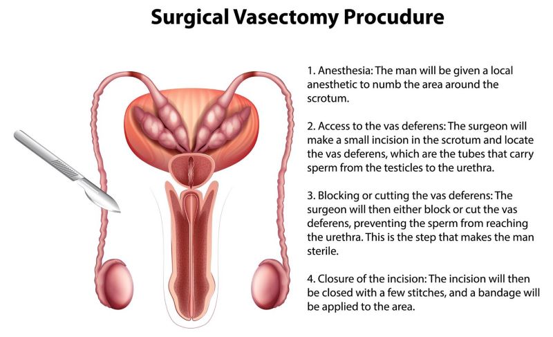 Ảnh mô phỏng quá trình phẫu thuật thắt ống dẫn tinh thông thường