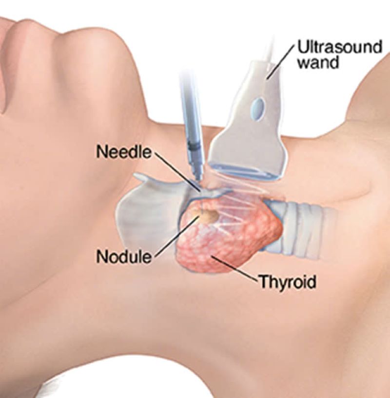 Hình ảnh minh họa FNA trên tuyến giáp