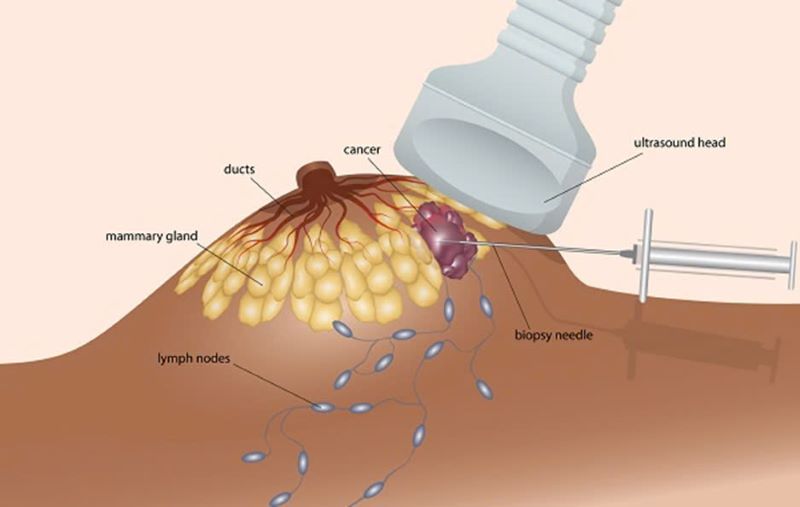 Hình ảnh minh họa FNA trên tuyến vú