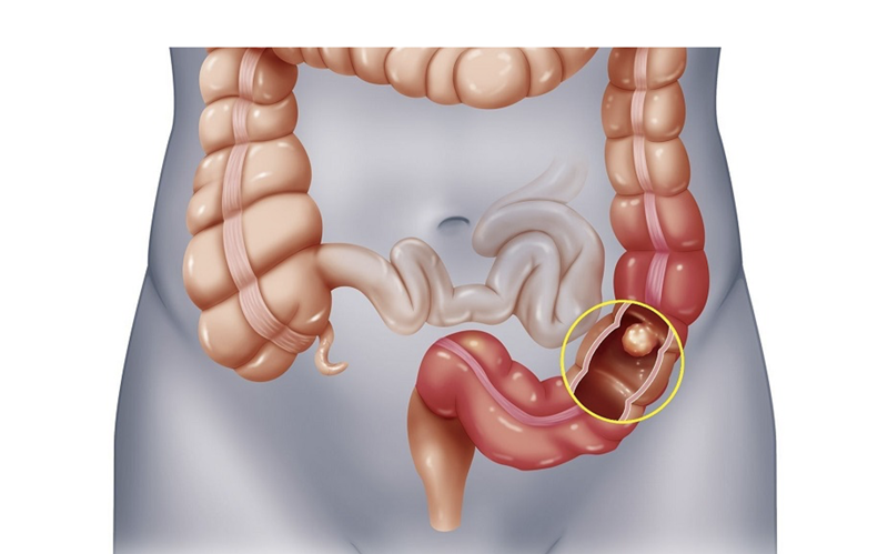 Triệu chứng ung thư đại tràng giai đoạn đầu thường khó nhận biết 