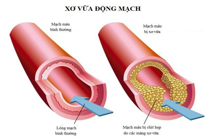 Xơ vữa động mạch là nguyên nhân hàng đầu gây hẹp động mạch chi dưới