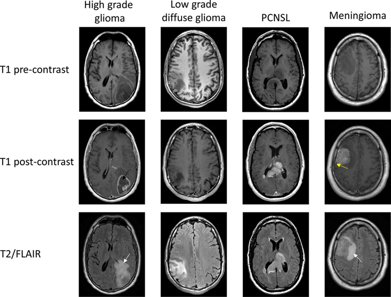 MRI là công cụ chẩn đoán hình ảnh quan trọng để chẩn đoán u não