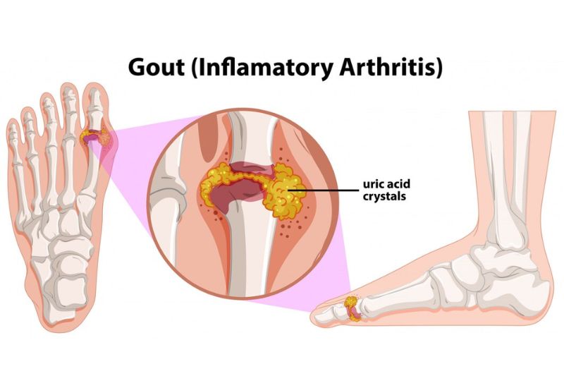 Bệnh viêm khớp gout đặc trưng bởi các hạt tophi bám quanh khớp, có thể gây tổn thương, ăn mòn khớp