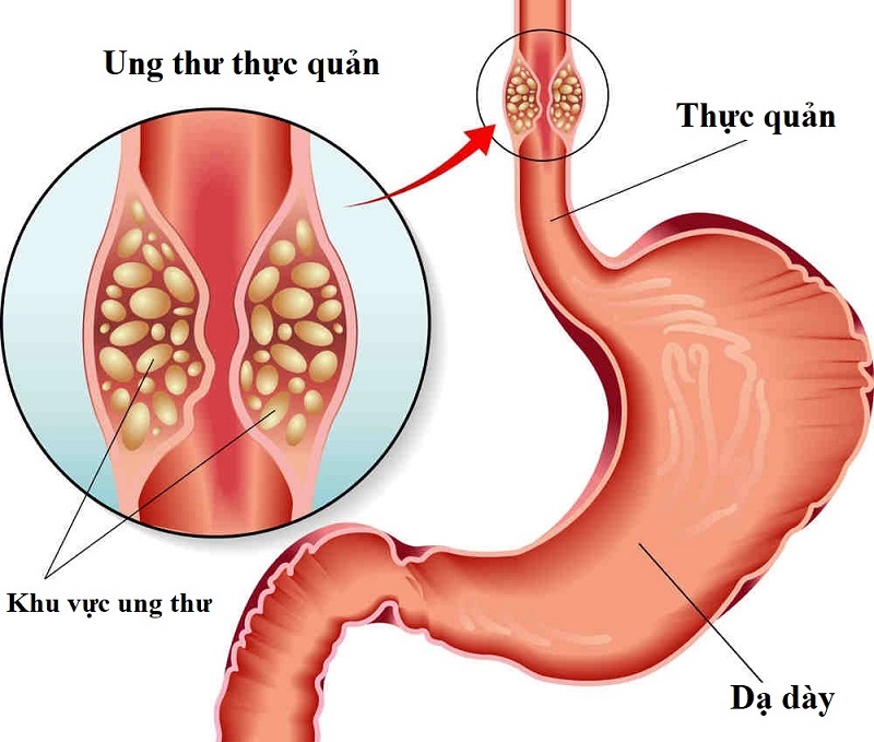 Các triệu chứng của ung thư thực quản thường dễ nhầm lẫn với các bệnh lý về đường tiêu hóa