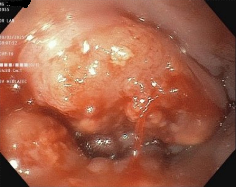 Kết quả nội soi thực quản của bệnh nhân có tổn thương u sùi loét