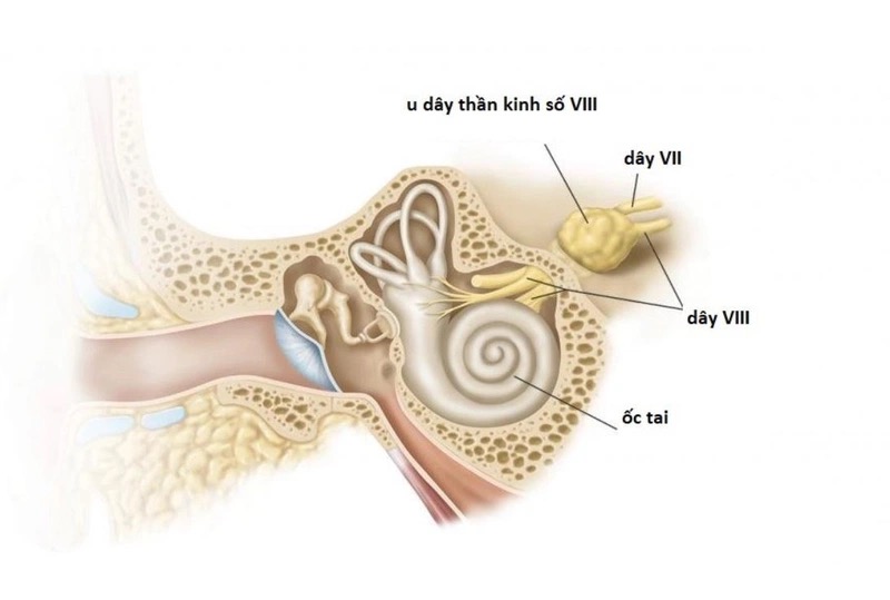 U dây thần kinh số 8 tiến triển chậm nhưng nhiều biến chứng nguy hiểm (Nguồn: Internet) 