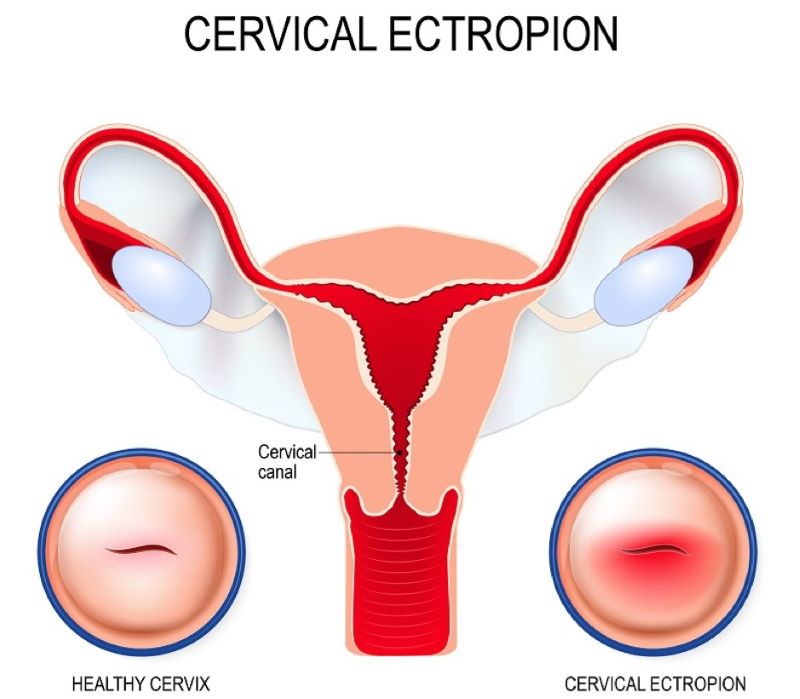 Biểu mô trụ phát triển ra mặt ngoài cổ tử cung có thể dẫn đến viêm nhiễm