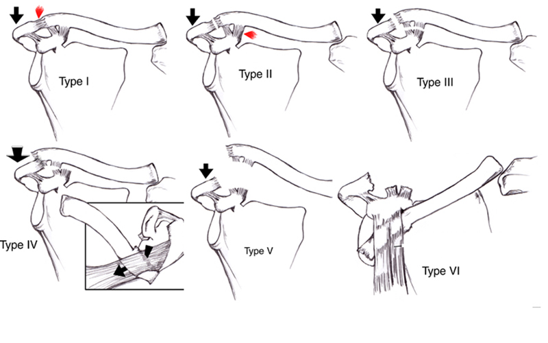 Ảnh minh họa 6 cấp độ trật khớp cùng vai đòn