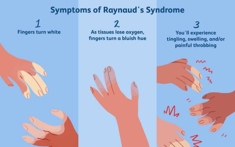 Những biểu hiện của hội chứng Raynaud