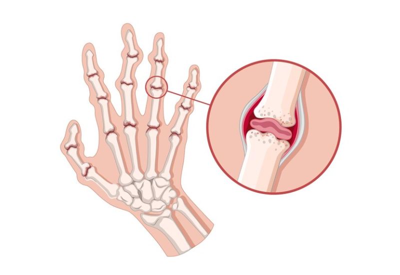 Ký sinh trùng tấn công vào hệ miễn dịch tại các khớp và gây viêm đau