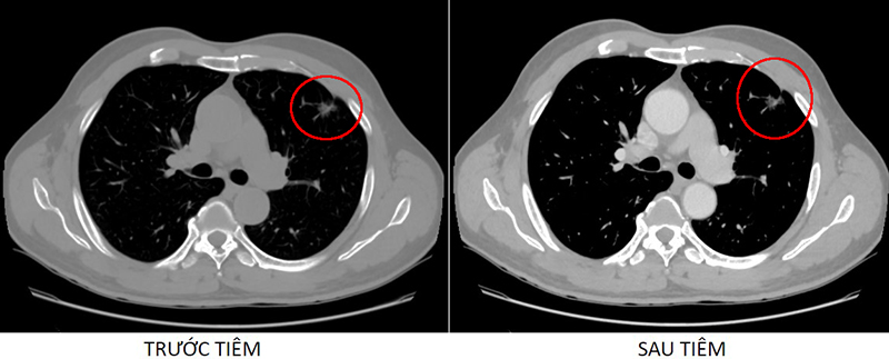 Hình ảnh chụp CT-Scanner trước và sau tiêm thuốc cản quang cho thấy nốt bán đặc thùy trên phổi trái  