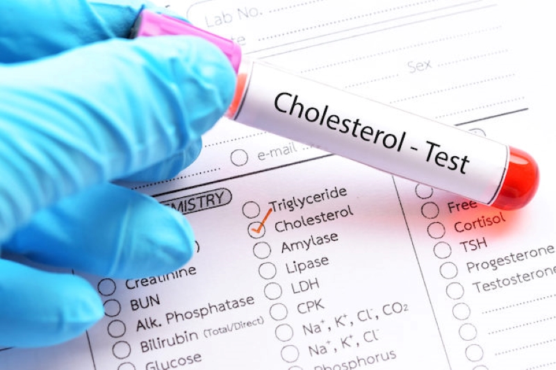 Chỉ số cholesterol toàn phần có mối liên quan trực tiếp tới sức khỏe tim mạch 