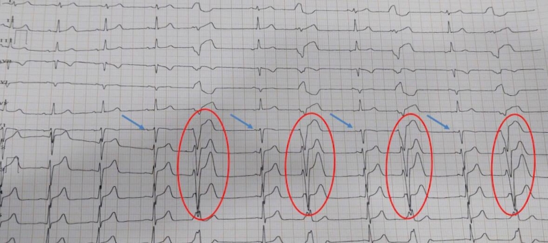 Kết quả điện tâm đồ của bệnh nhân phát hiện bất thường 