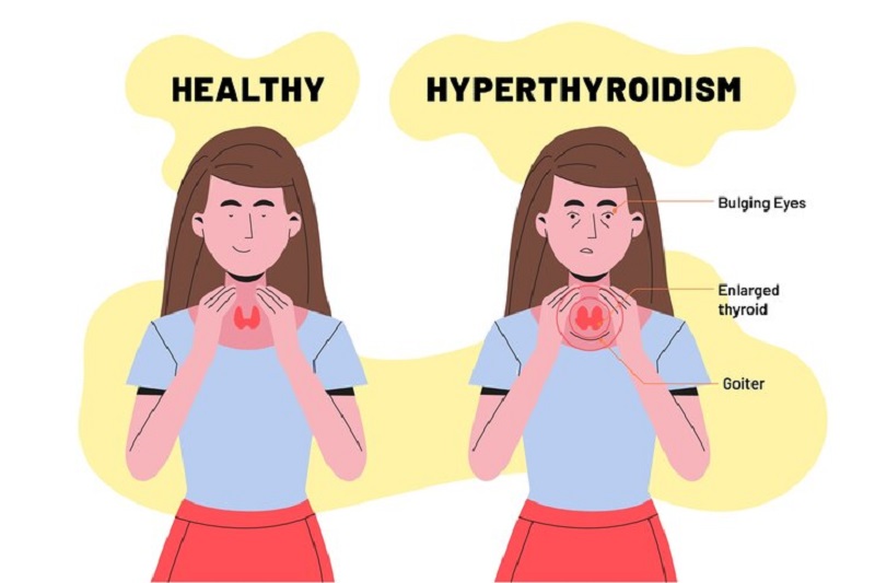 Mắt bị lồi trong bệnh Basedow gây cường giáp