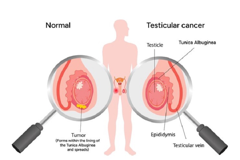 Thời điểm phát hiện và điều trị quyết định người mắc ung thư tinh hoàn sống được bao lâu