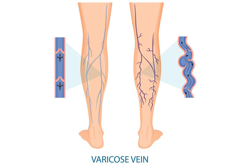 Hệ thống tĩnh mạch dưới chân có xu hướng bị suy giãn 