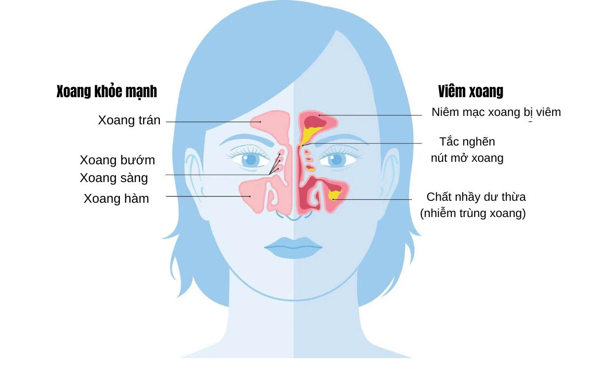 Viêm xoang là tình trạng viêm hoặc sưng mô lót trong xoang