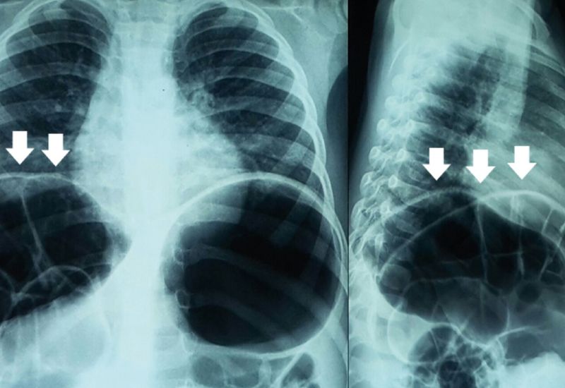  X-quang là phương pháp đơn giản và phổ biến nhằm phát hiện hội chứng Chilaiditi