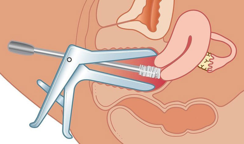 Dụng cụ “mỏ vịt” được các bác sĩ sử dụng trong khám phụ khoa. Ảnh minh họa 