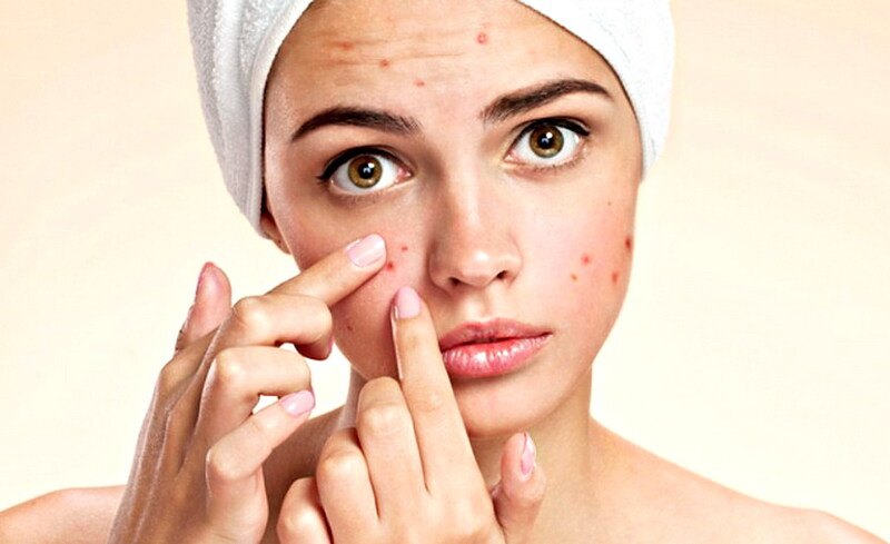 Có nhiều nguyên nhân khác nhau gây ra tình trạng mụn 