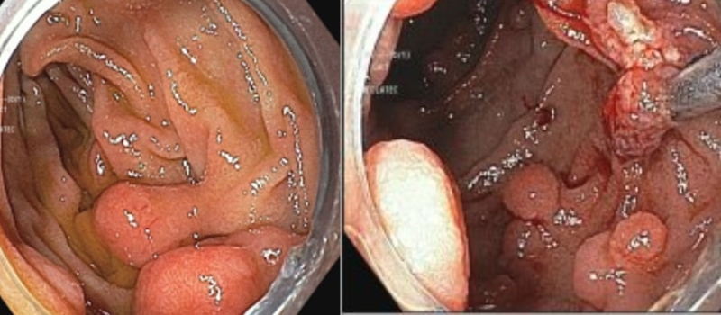 Hình ảnh nội soi tiêu hóa phát hiện nhiều polyp ở các vị trí bao gồm tá tràng, đại trực tràng 