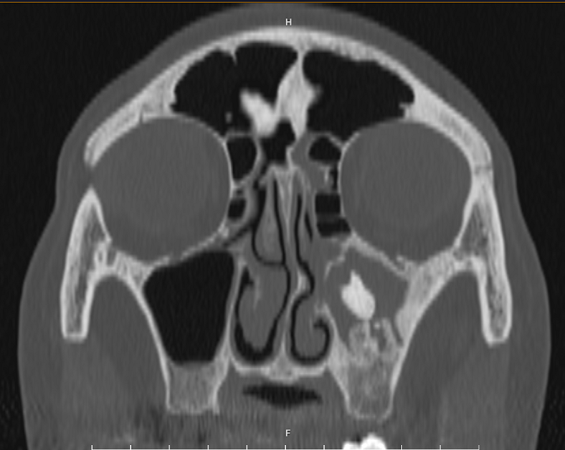 Hình ảnh CT scanner xoang của bệnh nhân có vẹo vách ngăn mũi sang trái, nấm xoang hàm trái tại BVĐK MEDLATEC