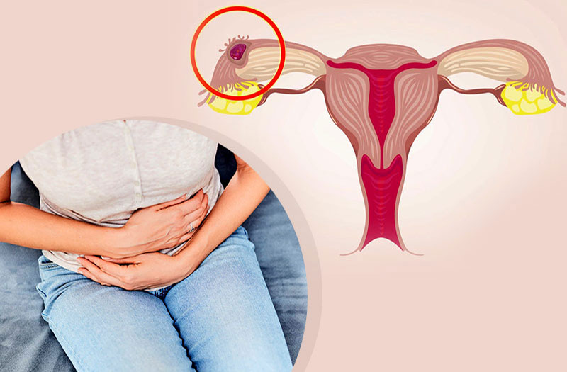 Tìm hiểu về nội soi thai ngoài tử cung và tác dụng của nó