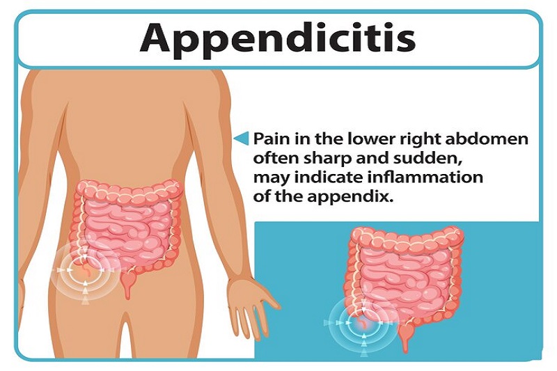 Viêm ruột thừa không điều trị kịp thời khiến ruột thừa bị vỡ gây biến chứng viêm phúc mạc