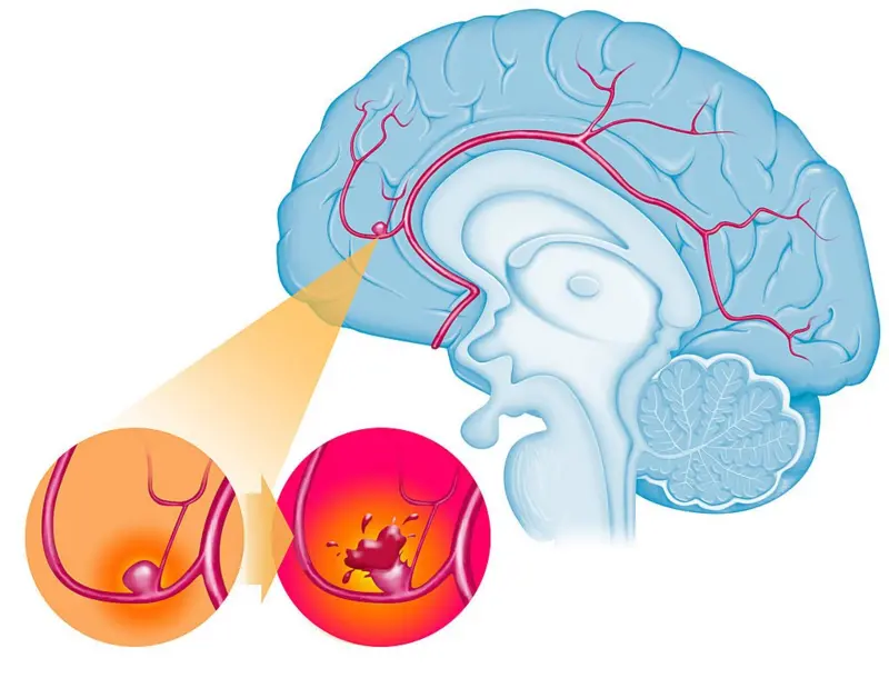 Vỡ túi phình mạch máu não được ví như “quả bom” có thể đe dọa đến tính mạng của người bệnh