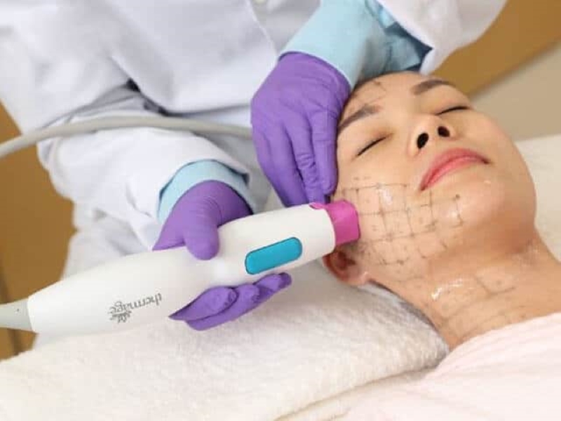 Kỹ thuật laser vi điểm là phương pháp điều trị sẹo đáy nhọn mang lại hiệu quả 