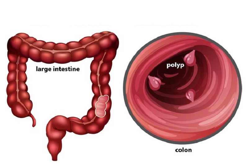 Các polyp xuất hiện trong đại tràng