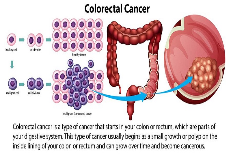 Sự tiến triển của polyp thành khối u đại tràng ác tính