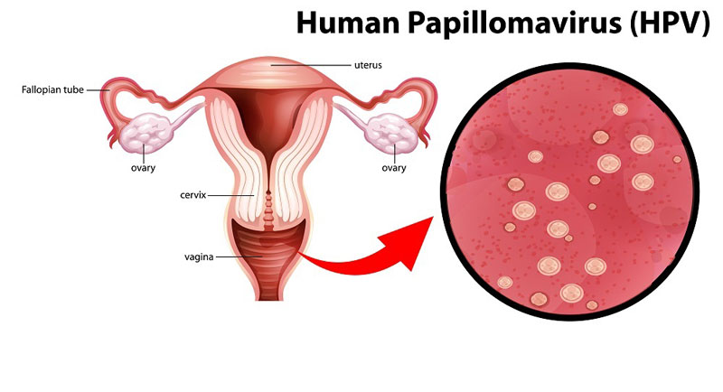 HPV type 52 thuộc nhóm 12 chủng virus HPV nguy hiểm, có thể gây ung thư