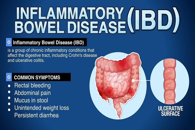 Mắc bệnh Crohn có thể là nguyên nhân gây tắc ruột